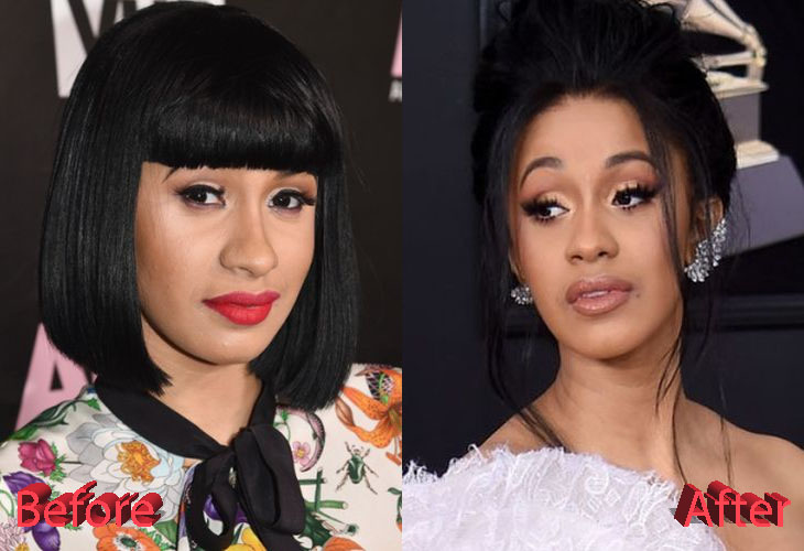 Cardi B Before and After Plastic Surgery