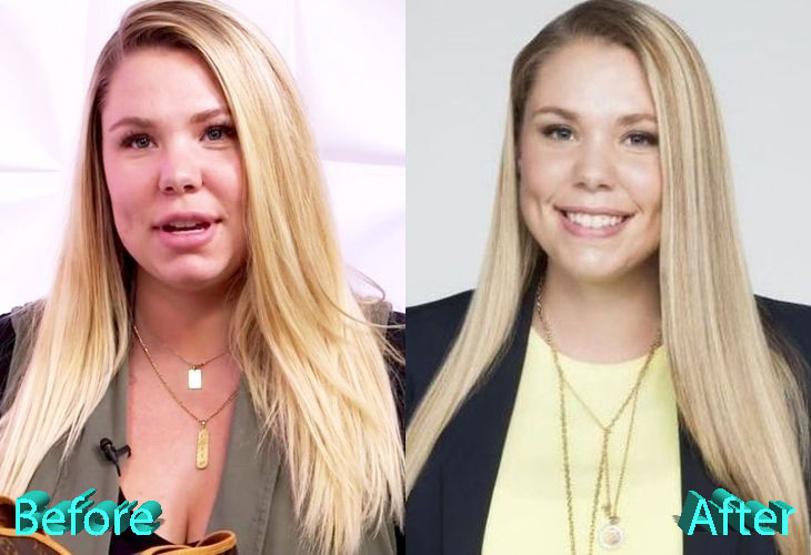 Kailyn Lowry Before and After Cosmetic Surgery