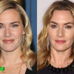 Kate Winslet Before and After Cosmetic Surgery