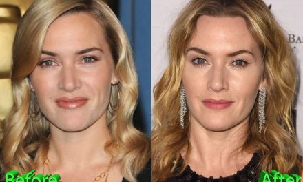Kate Winslet Plastic Surgery: The Queen Of The Silver Screen