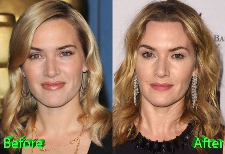 Kate Winslet Before and After Cosmetic Surgery