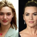Kate Winslet Before and After Plastic Surgery 150x150