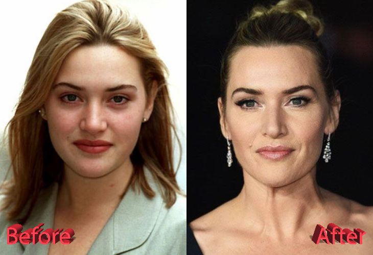 Kate Winslet Before and After Plastic Surgery