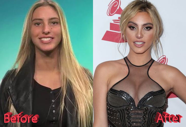 Lele Pons Before and After Nose Job Surgery