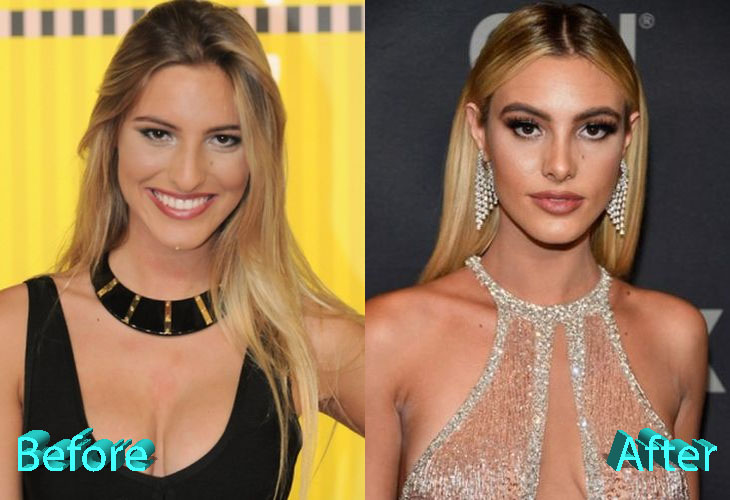 Lele Pons Before and After Nose Job