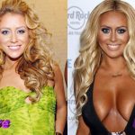 Aubrey ODay Before and After Cosmetic Surgery 150x150