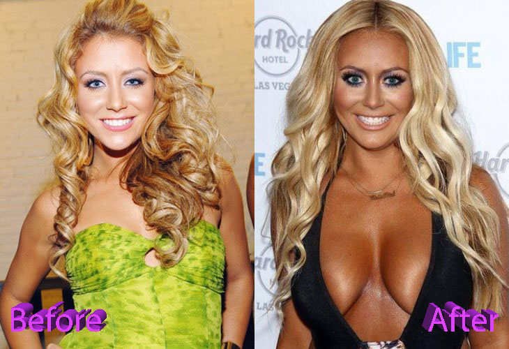 Aubrey ODay Before and After Cosmetic Surgery