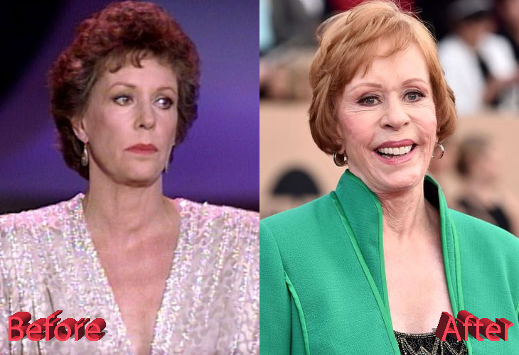 Carol Burnett Before and After Cosmetic Surgery