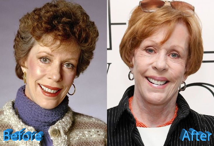Carol Burnett Plastic Surgery: Is It An Addiction Or Not?