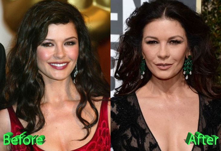 Catherine Zeta Jones Before and After Cosmetic Surgery