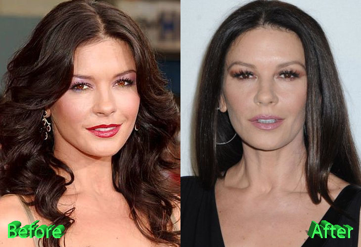 Catherine Zeta Jones Plastic Surgery: New Look For The Comeback