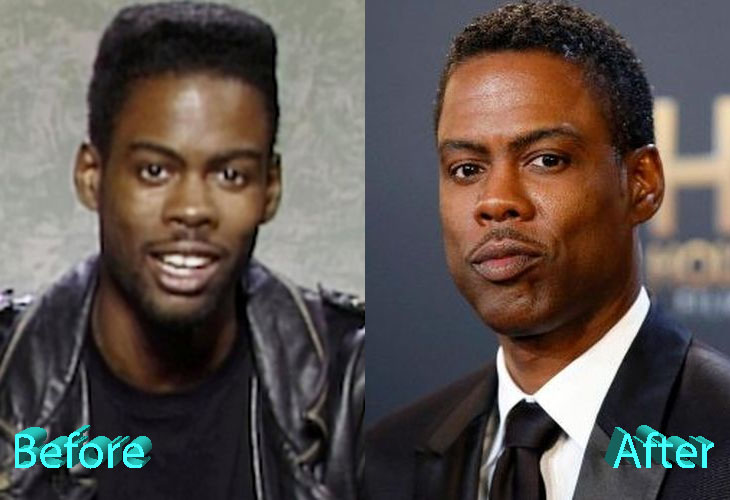Chris Rock Before and After Cosmetic Surgery
