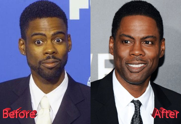 Chris Rock Before and After Plastic Surgery