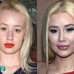 Iggy Azalea Before and After Cosmetic Surgery