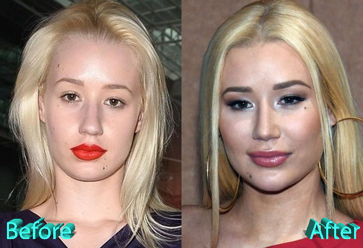 Iggy Azalea Before and After Cosmetic Surgery