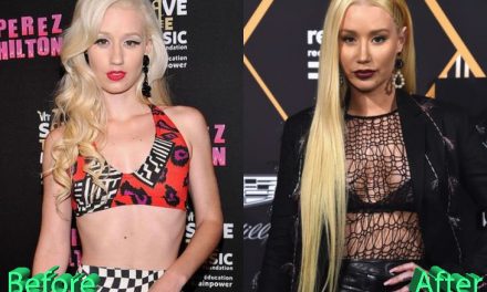 Iggy Azalea Plastic Surgery: The Recipe For Success