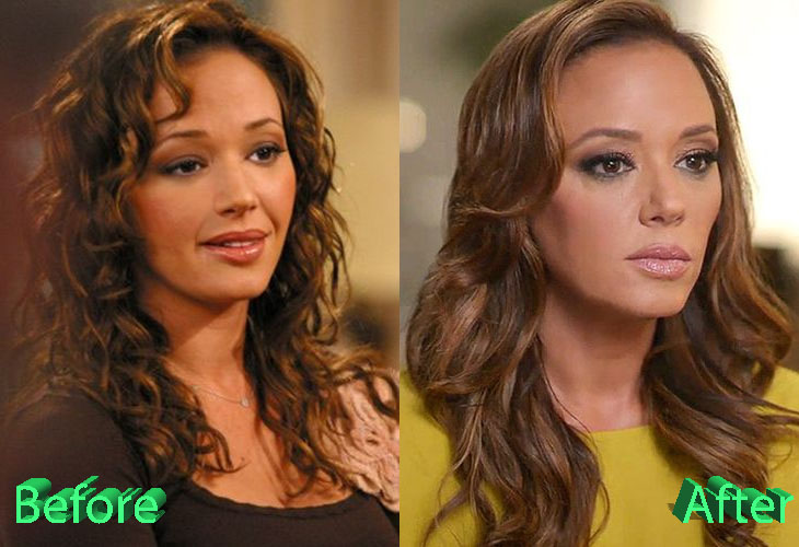 Leah Remini Before and After Cosmetic Surgery