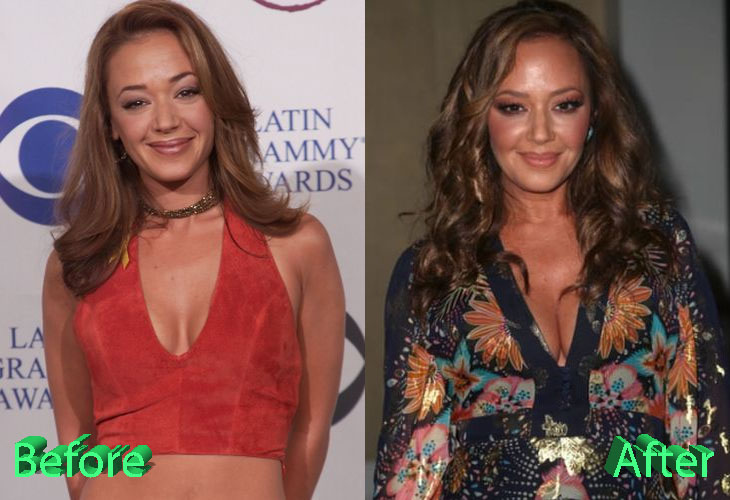 Leah Remini Before and After Plastic Surgery