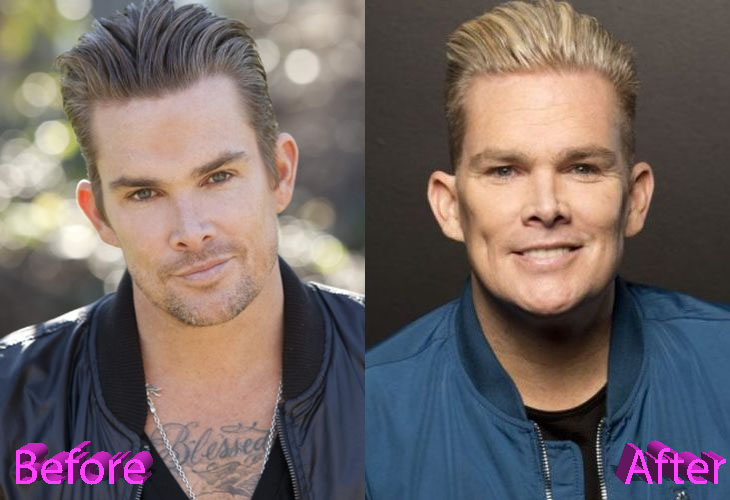 Mark McGrath Before and After Cosmetic Surgery