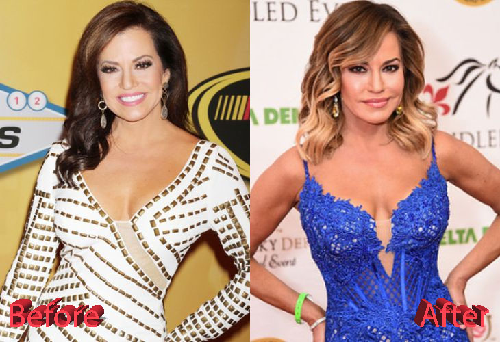 Robin Meade Before and After Cosmetic Surgery