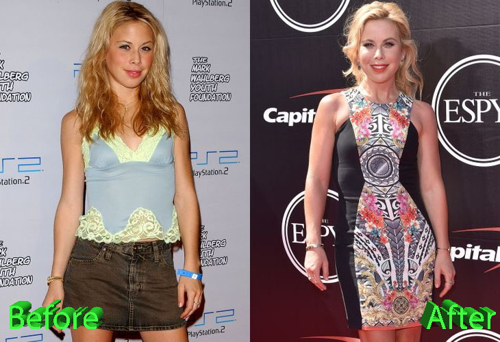 Tara Lipinski Before and After Cosmetic Surgery