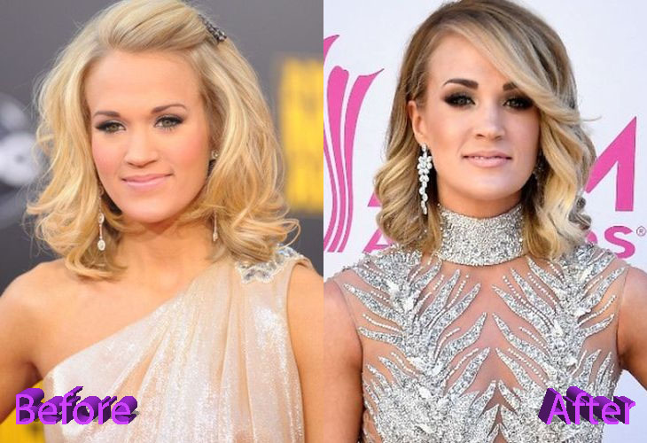 Carrie Underwood Before and After Cosmetic Surgery