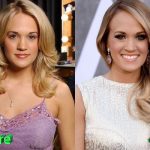 Carrie Underwood Before and After Plastic Surgery