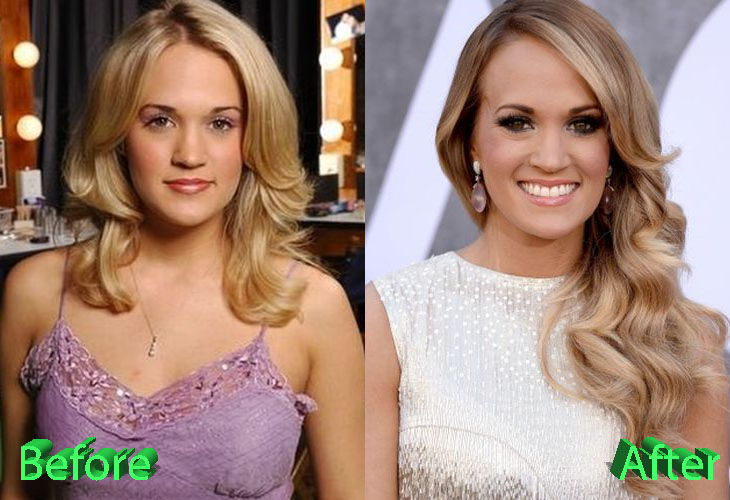 Carrie Underwood Before and After Plastic Surgery