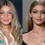Gigi Hadid Before and After Cosmetic Surgery 150x150