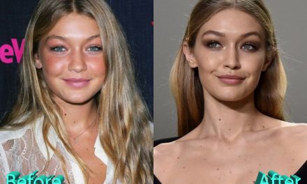 Gigi Hadid Plastic Surgery: Looking Better Than Ever