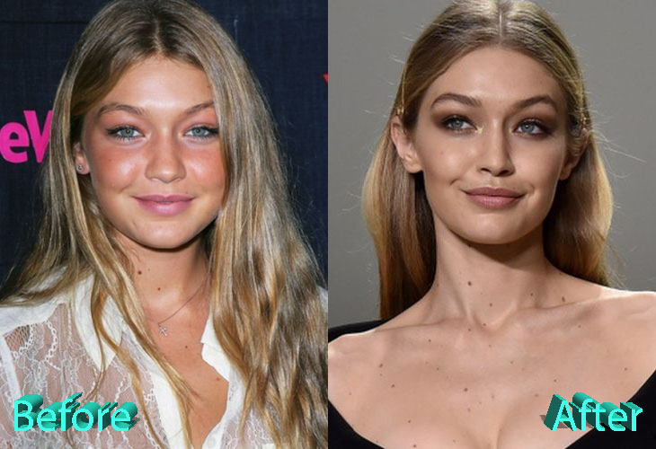 Gigi Hadid Plastic Surgery: Looking Better Than Ever