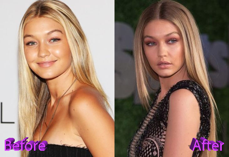 Gigi Hadid Before and After Plastic Surgery