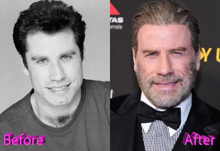 John Travolta Before and After Cosmetic Surgery