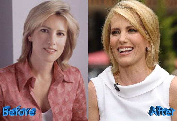 Laura Ingraham Plastic Surgery Just Media Gossips?