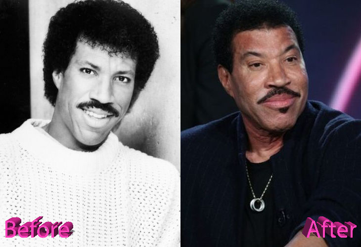 Lionel Richie Plastic Surgery: All You Need To Know About It