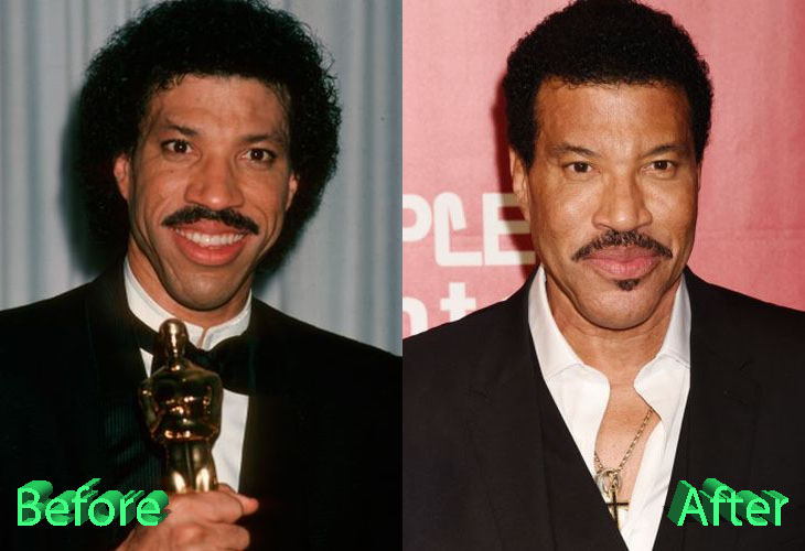 Lionel Richie Before and After Plastic Surgery