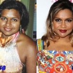 Mindy Kaling Before and After Cosmetic Surgery