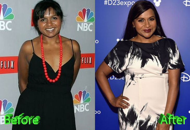 Mindy Kaling Before and After Plastic Surgery