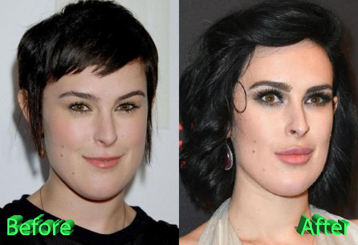 Rumer Willis Before and After Cosmetic Surgery