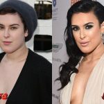 Rumer Willis Before and After Plastic Surgery