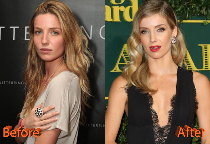 Annabelle Wallis Before and After Rhinoplasty