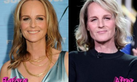 Helen Hunt Plastic Surgery Procedures and Results