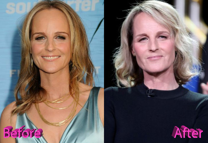 Helen Hunt Plastic Surgery Procedures and Results