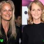 Helen Hunt Before and After Plastic Surgery 150x150