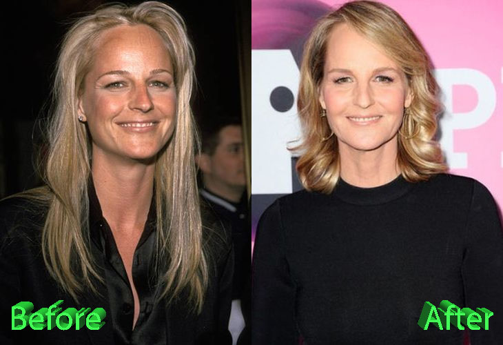Helen Hunt Before and After Plastic Surgery