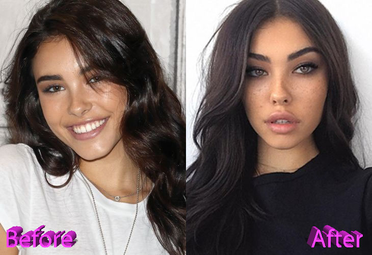 Madison Beer Before and After Cosmetic Surgery