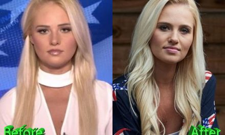 Tomi Lahren Plastic Surgery: Making Headlines For Her Face