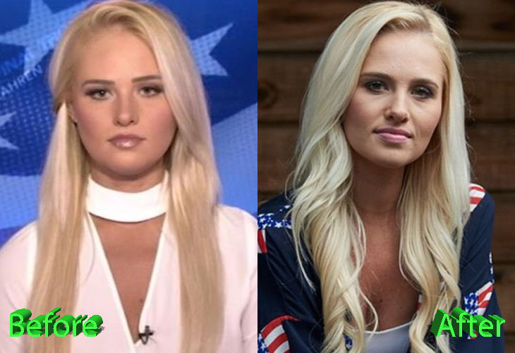 Tomi Lahren Before and After Cosmetic Surgery. 