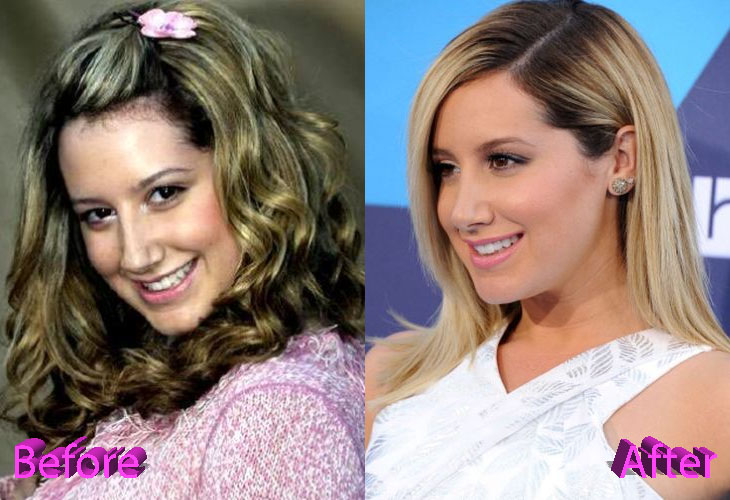 Ashley Tisdale Before and After Nose Job Surgery
