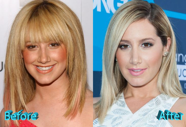 Ashley Tisdale Nose Job: The Fans Are Quite Confused